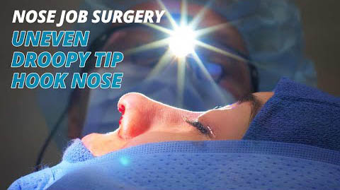 Fix Asymmetric Nose with Rhinoplasty Surgery