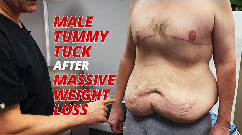 Male Tummy Tuck After Massive Weight Loss