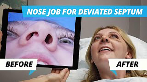 Nose Job Surgery for Deviated Septum