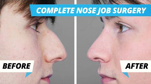Nose Job Surgery – Pre-Op > Surgery > 1 Week Post Op > 8 Week Post Op