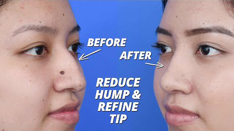 Nose Job To Reduce Hump And Refine Tip