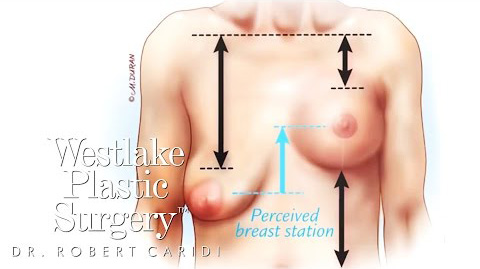 Perfect Candidate – Breast Augmentation And Reduction