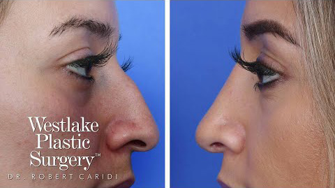 Rhinoplasty Surgery Experience – A Nose Job Before And After Journey