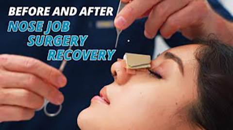 Rhinoplasty Surgery Recovery – Before and After Nose Job