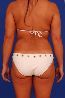 Female Liposuction Before & After Image
