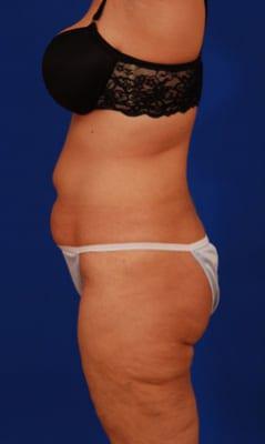 Female Liposuction Before & After Image