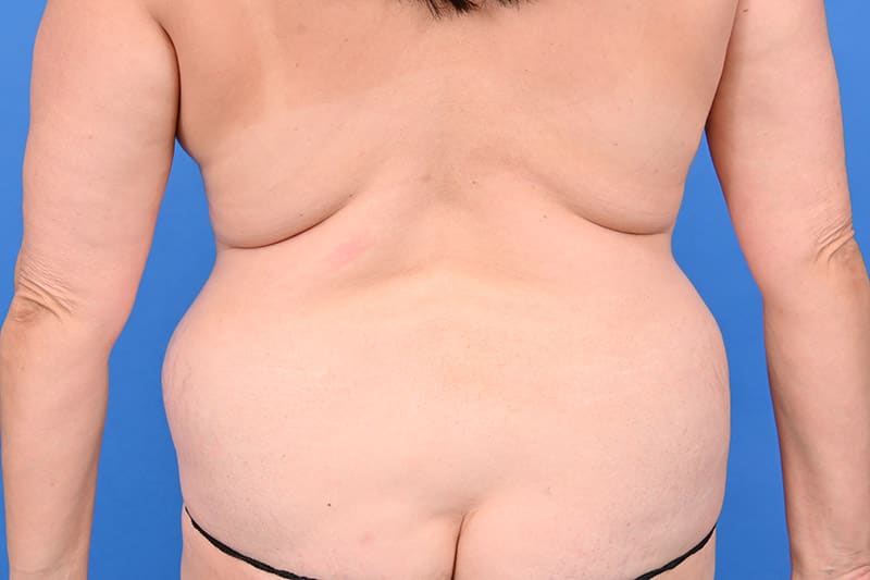 Female Liposuction Before & After Image