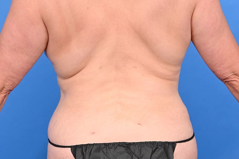 Female Liposuction Before & After Image