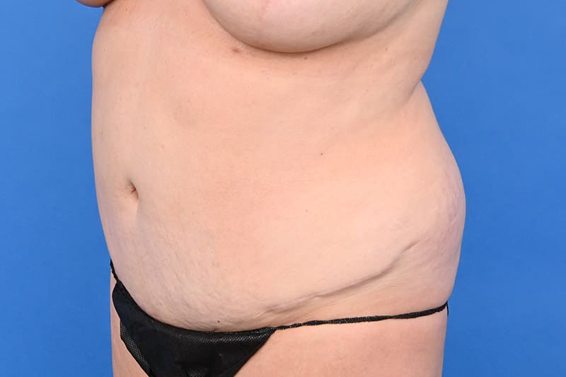 Female Liposuction Before & After Image