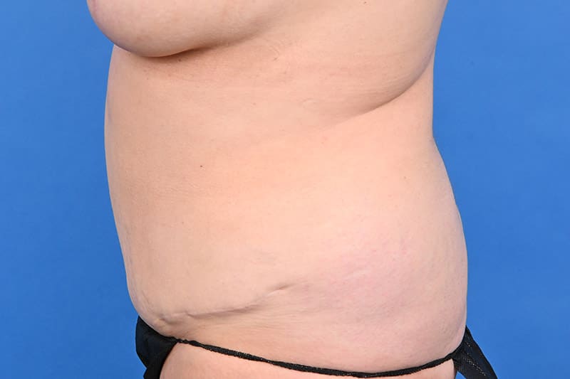 Female Liposuction Before & After Image
