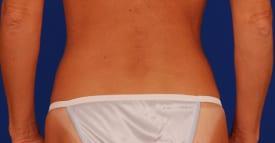 Mini Tummy Tuck Before & After Image
