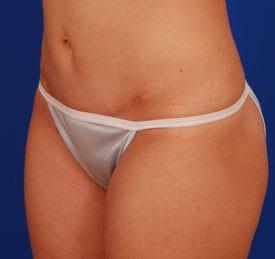 Mini Tummy Tuck Before & After Image