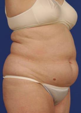 Tummy Tuck Before & After Image