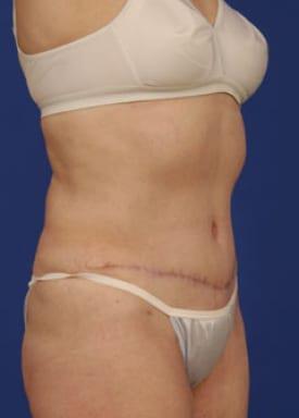 Tummy Tuck Before & After Image