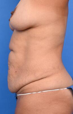 Tummy Tuck Before & After Image