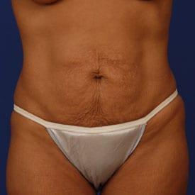 Tummy Tuck Before & After Image