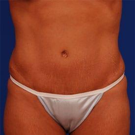 Tummy Tuck Before & After Image