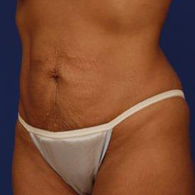 Tummy Tuck Before & After Image