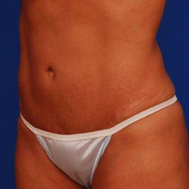 Tummy Tuck Before & After Image