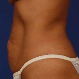 Tummy Tuck Before & After Image