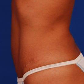 Tummy Tuck Before & After Image