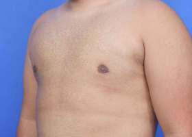 Gynecomastia Surgery Before & After Image