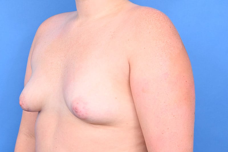 Breast Augmentation Before & After Image