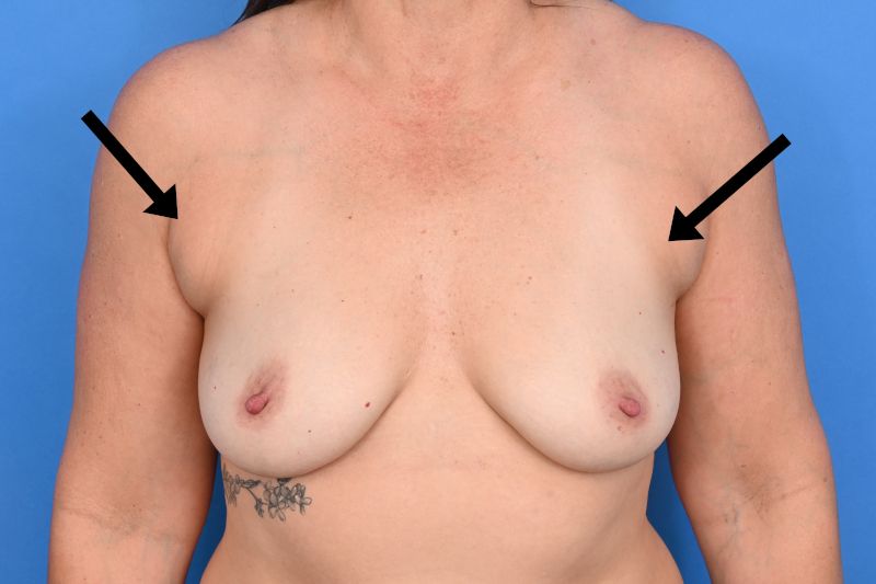 Breast Augmentation Before & After Image