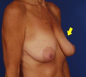 Breast Lift With Implants Before & After Image