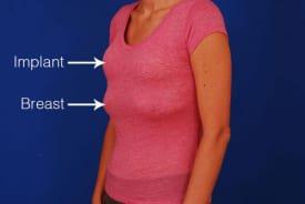 Breast Lift With Implants Before & After Image