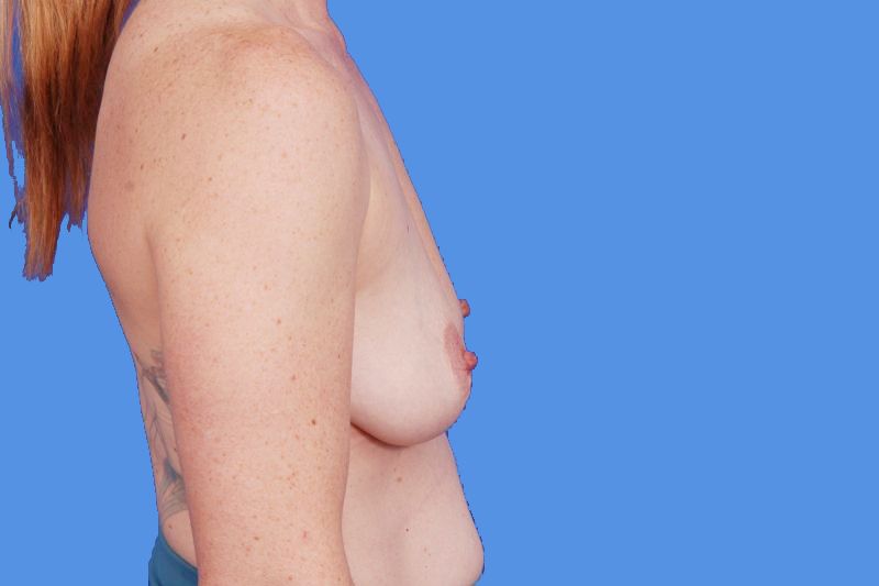 Breast Lift With Implants Before & After Image