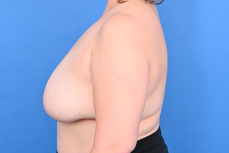 Breast Reduction Before & After Image