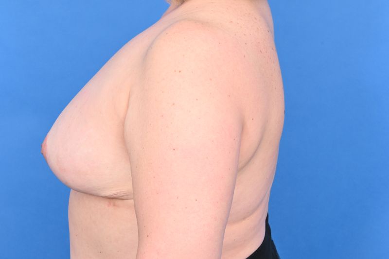 Breast Reduction Before & After Image