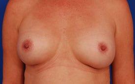 Breast Revision Before & After Image