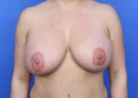 Breast Revision Before & After Image