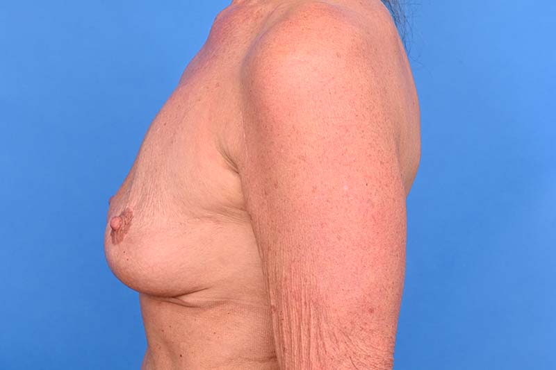 Breast Implant Removal Before & After Image