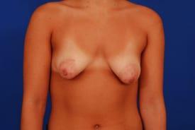 Tuberous Breasts Correction Before & After Image