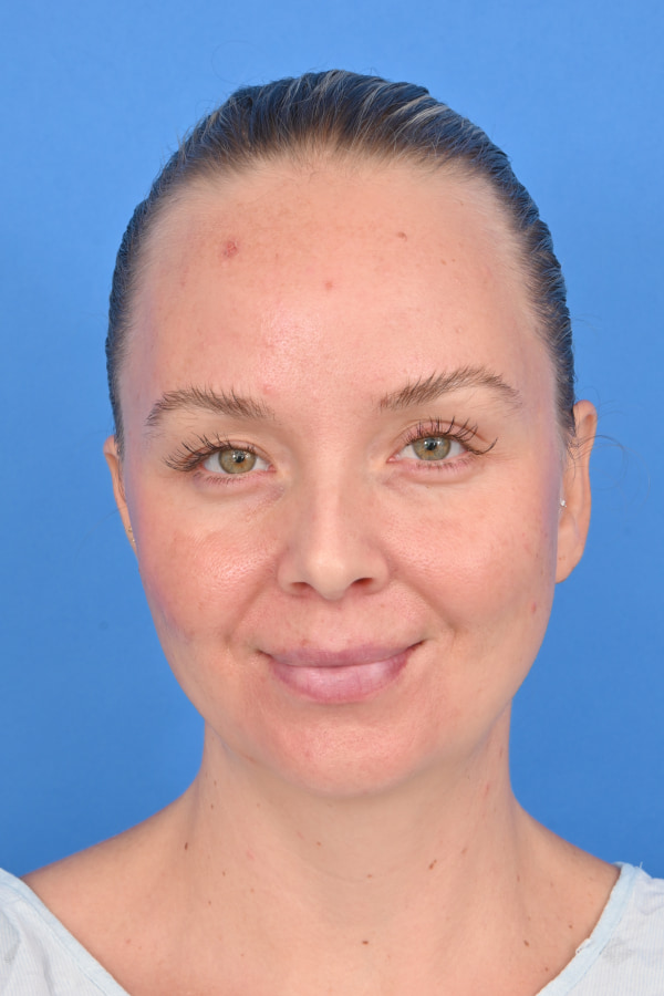 Neck Liposuction Before & After Image