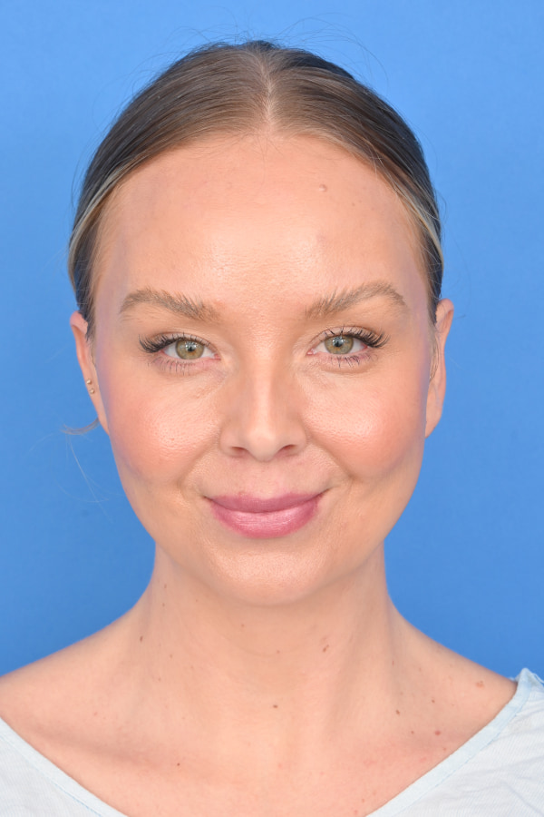 Neck Liposuction Before & After Image