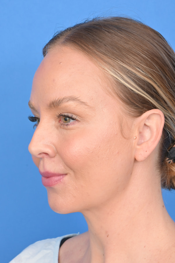 Neck Liposuction Before & After Image