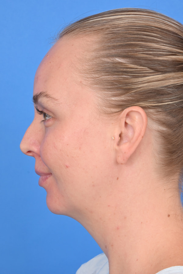 Neck Liposuction Before & After Image
