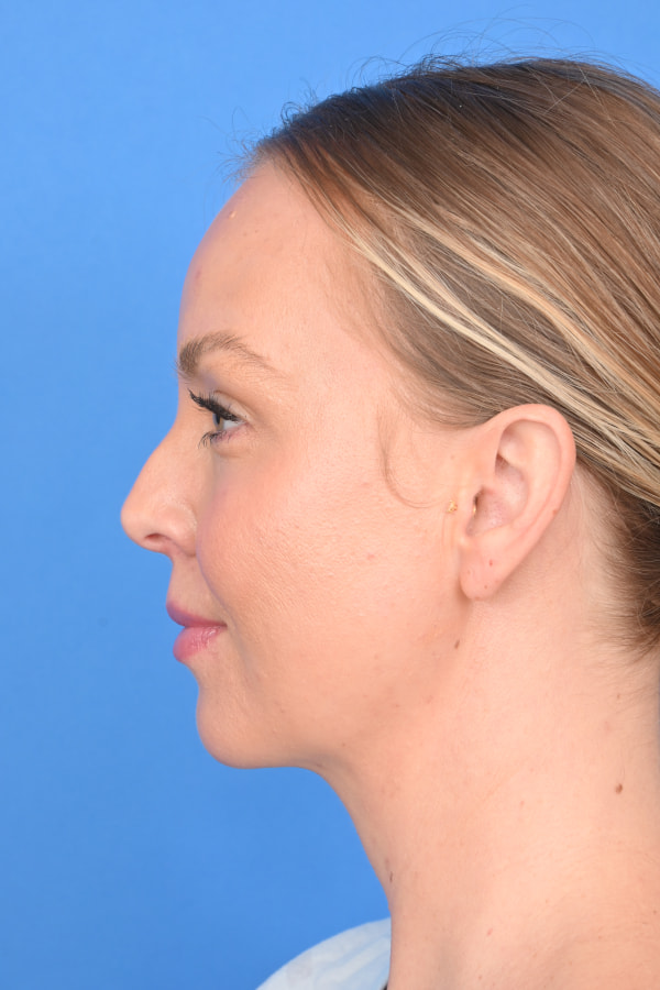 Neck Liposuction Before & After Image