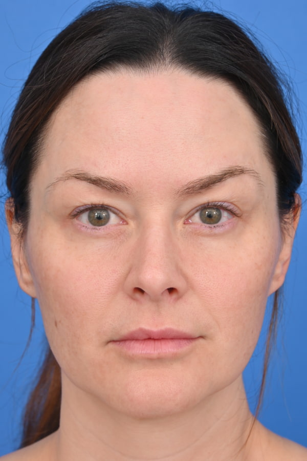 Neck Liposuction Before & After Image