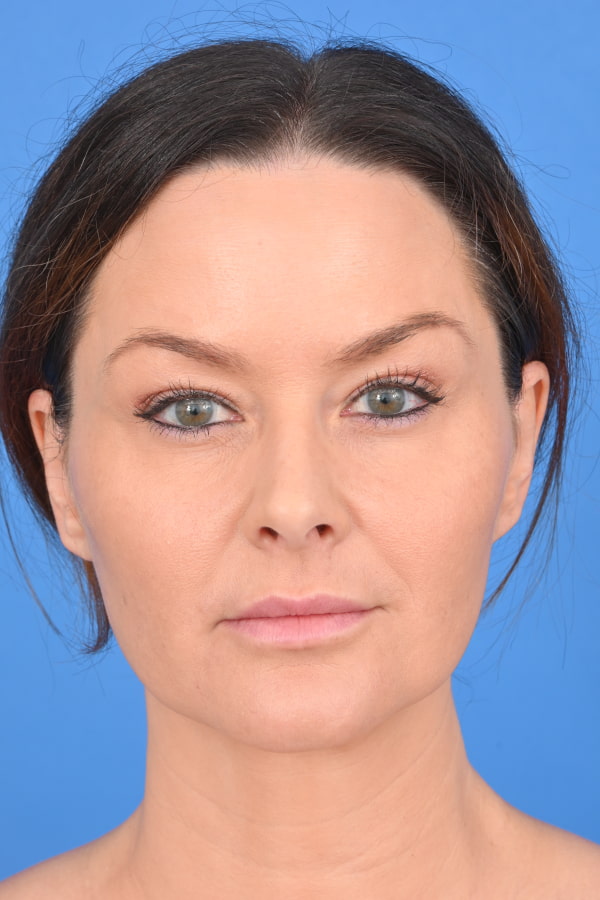 Neck Liposuction Before & After Image