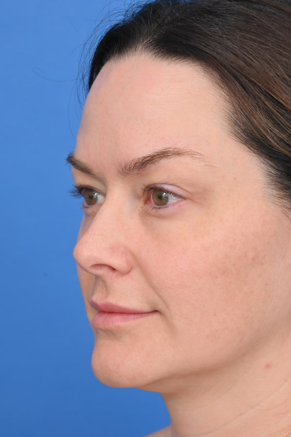 Neck Liposuction Before & After Image