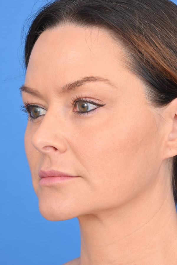 Neck Liposuction Before & After Image