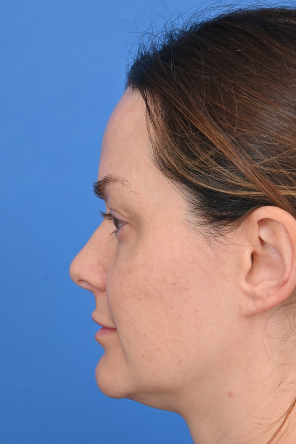Neck Liposuction Before & After Image