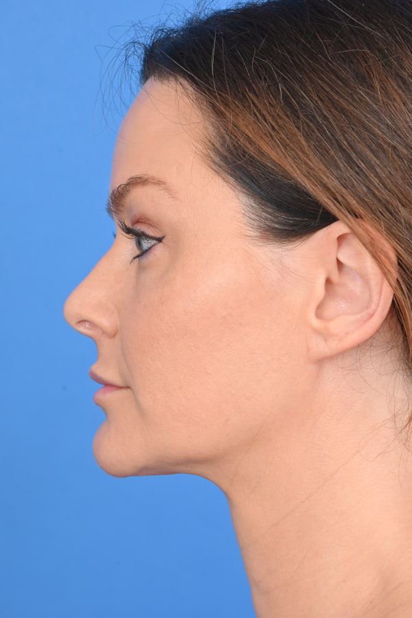 Neck Liposuction Before & After Image