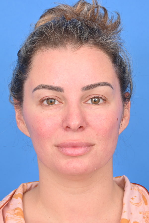 Neck Liposuction Before & After Image