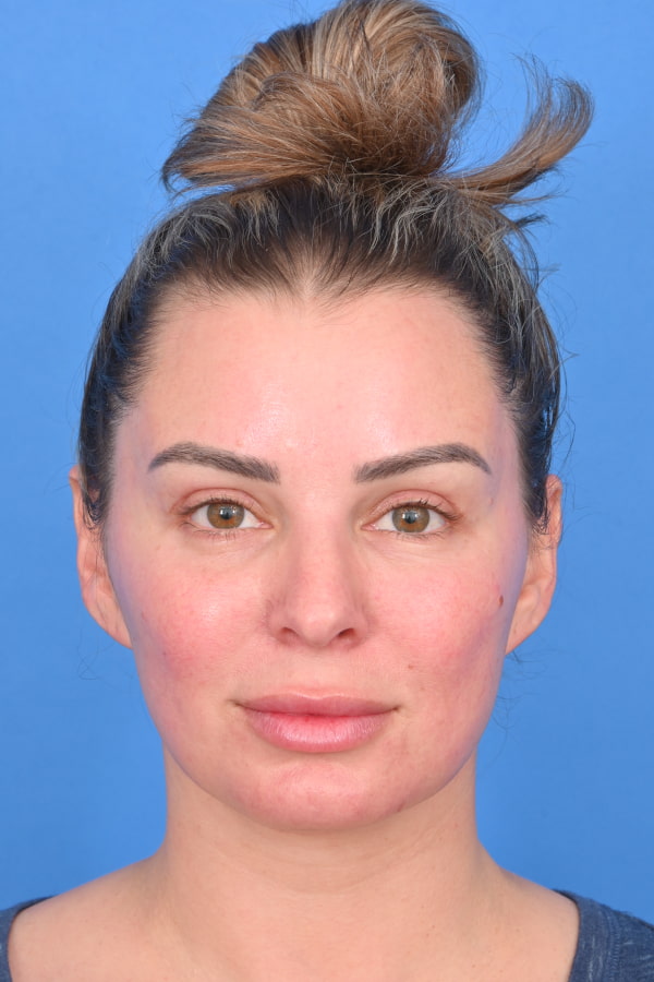 Neck Liposuction Before & After Image